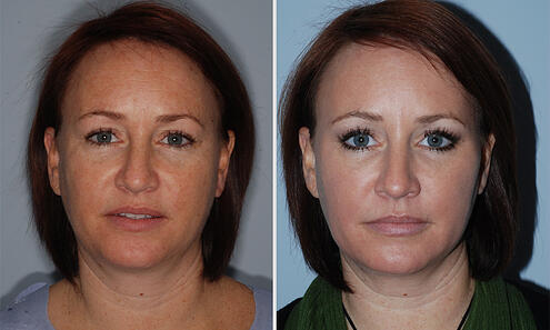 eye lift and filler for hollow eyes