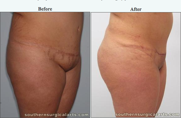 Tennessee Cosmetic Surgery Blog Southern Surgical Arts