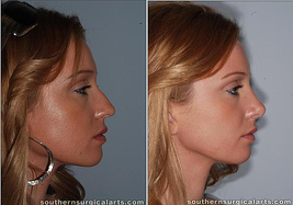 nose reshaping