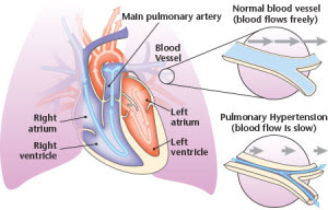 understanding pulmonary hypertension Pulmonary hypertension is rarely discovered in a routine medical examination, and in its later stages, the signs of the disease can be confused with other conditions affecting the heart and lungs pulmonary hypertension is a diagnosis of exclusion. understanding pulmonary hypertension Pulmonary hypertension is rarely discovered in a routine medical examination, and in its later stages, the signs of the disease can be confused with other conditions affecting the heart and lungs pulmonary hypertension is a diagnosis of exclusion.