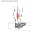 Treating Plantar Fasciitis
