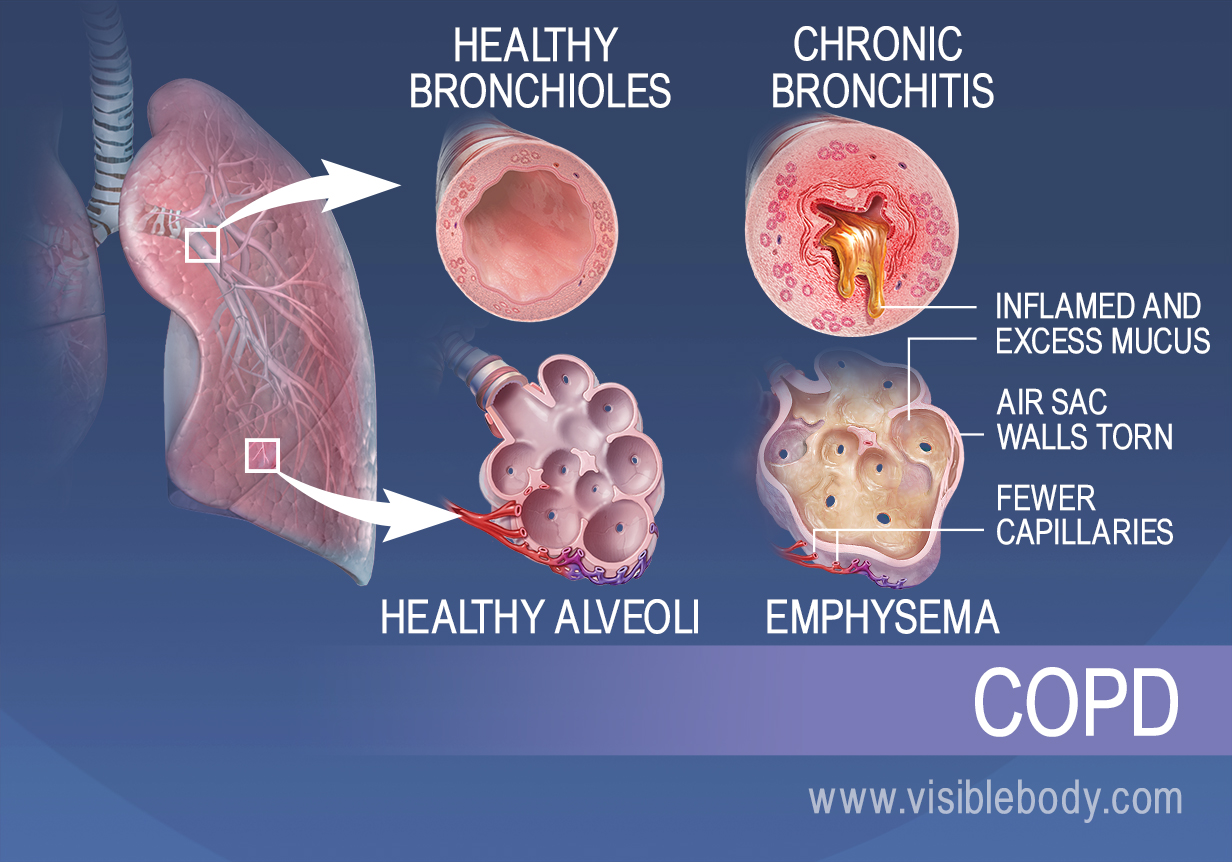 bronchitis contagious lengthy