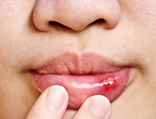 dental-health-and-canker-sores