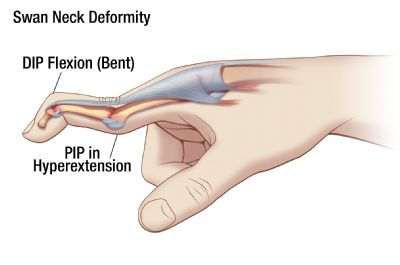 Swan Neck Splint