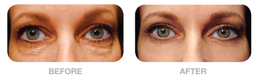 Plastic Surgery for Under Eye Bags: What Are the Options?