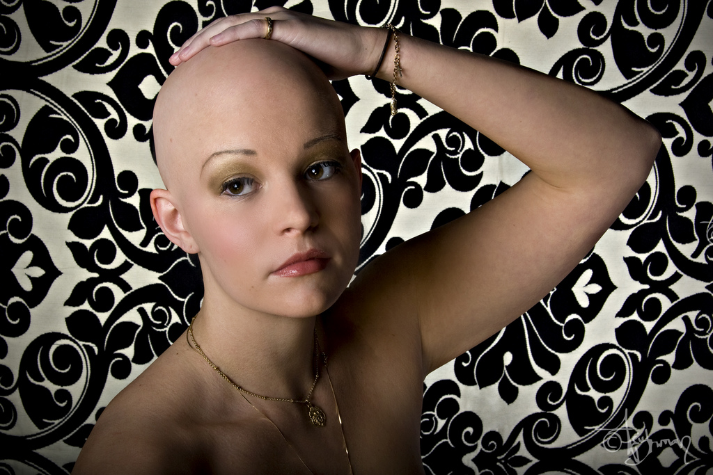 ALOPECIA.CZ - alopecia, alopecie, vypadávání vlasů, růst ...
