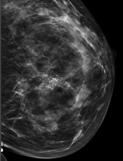 Mammogram - calcifications Information