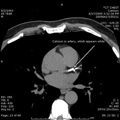 What Does a Cardiac Calcium Score Show?