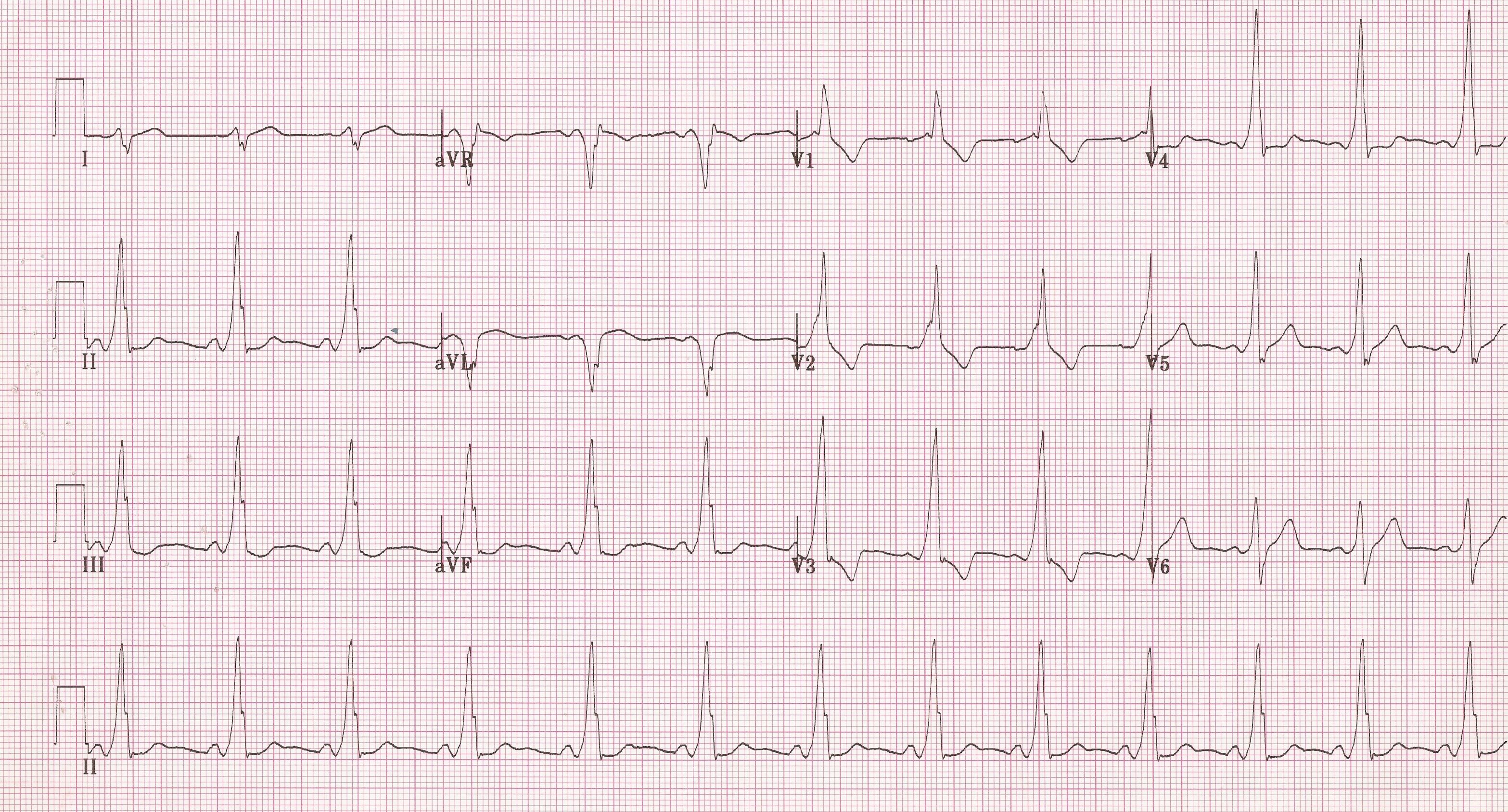 EKG