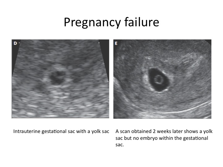 what-is-a-good-first-hcg-level-after-embryo-transfer