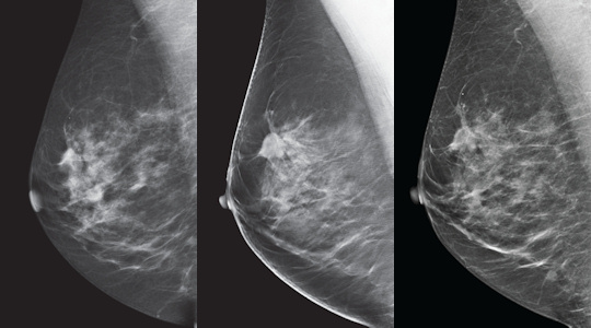 ge tomosynthesis fda Senoclaire (ge breast tomosynthesis) is an add-on to the existing, fda- approved senographe essential full field digital mammography (ffdm) system that. ge tomosynthesis fda Senoclaire (ge breast tomosynthesis) is an add-on to the existing, fda- approved senographe essential full field digital mammography (ffdm) system that.