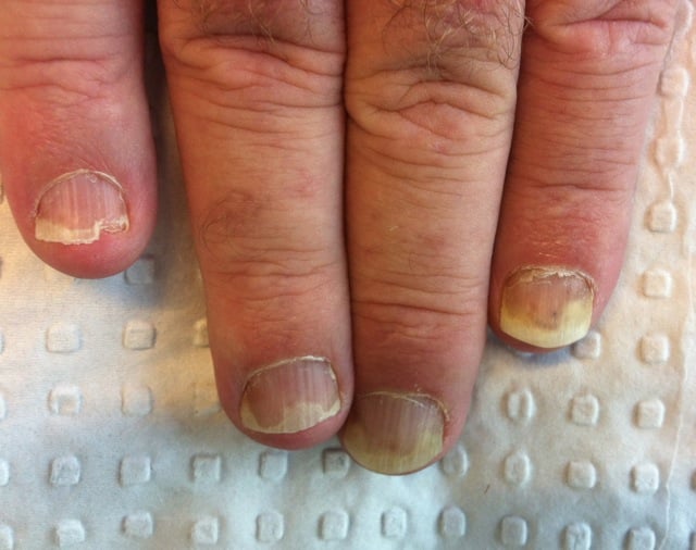 The nails giveth the diagnosis