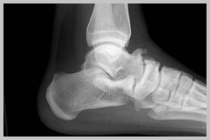 ankle