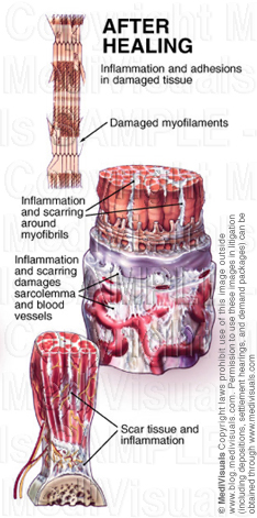 Soft Tissue Injury - Cervical and Lumbar Strain