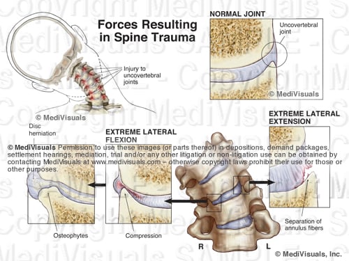 Understanding the Osteophyte/Disc Complex in Spinal Trauma
