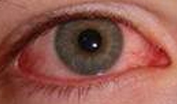 Herpes keratitis showing red eyes but no dendritic ulcer or fluorescein stain eye doctor in Austin resized 600