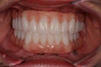 Advances in Removable Prosthodontics
