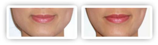 masseter hypertrophy