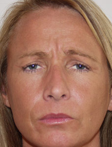 botox before