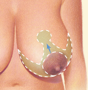 Breast Reduction 06