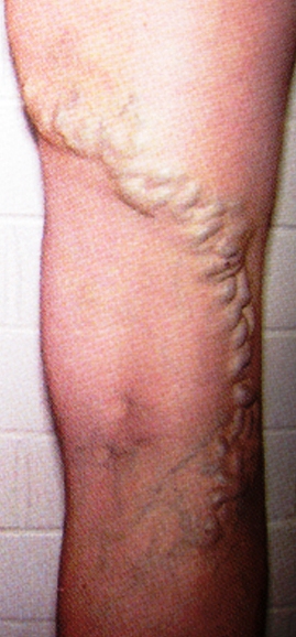 Varicose veins treated the modern way