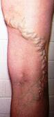 varicose vein