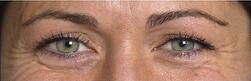 crows feet