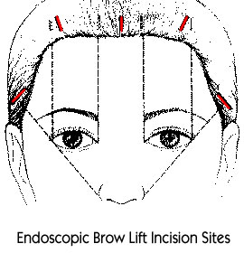 Brow lift