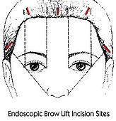 EndoscopicBrowLiftIncisionS