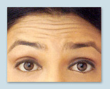 foreheadwrinkles