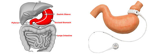 Gastric sleeve vs lap band
