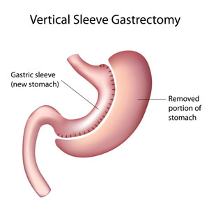 gastric sleeve