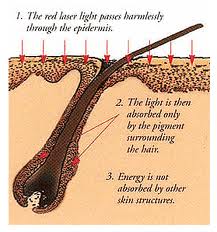 laser hair removal