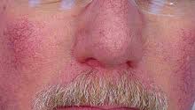 facial veins from rosacea