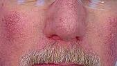 rosacea