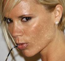 acne scarring