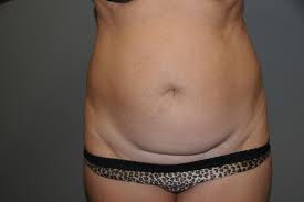 liposuction