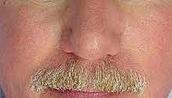 rosacea