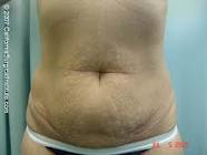 tummy tuck