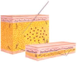 liposuction