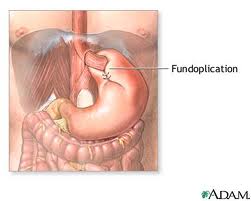 fundoplication