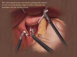 hiatal hernia repair