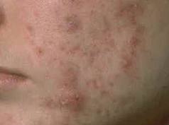 acne scarring