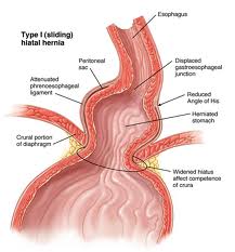 hiatal hernia