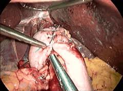 fundoplication