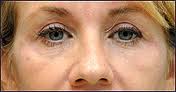 aging eyes