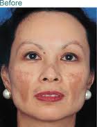 melasma