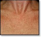 chest pigmentation