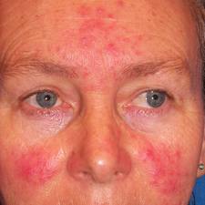 rosacea
