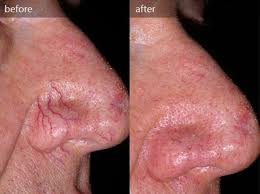 nose veins
